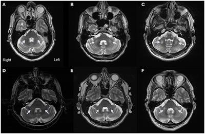 Presence of Middle Cerebellar Peduncle Sign in FMR1 Premutation Carriers Without Tremor and Ataxia